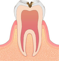 C2：進行した虫歯