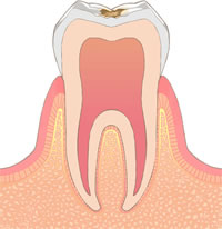 C1：初期の虫歯