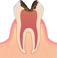 C3：歯髄に達した虫歯